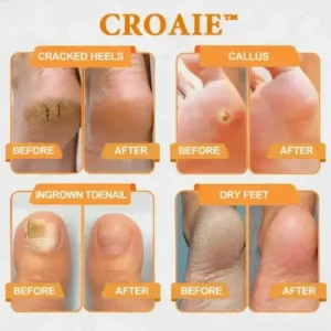 CROAIE™ Bee Venom & Herbal Slimming Foot Patches for Lymphatic Support and Blood Sugar Balance